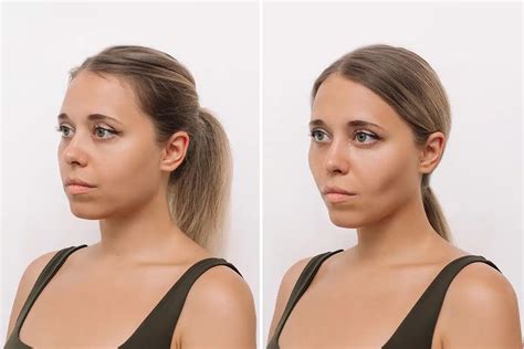 buccal fettpute|Buccal Fat Pad Reduction .